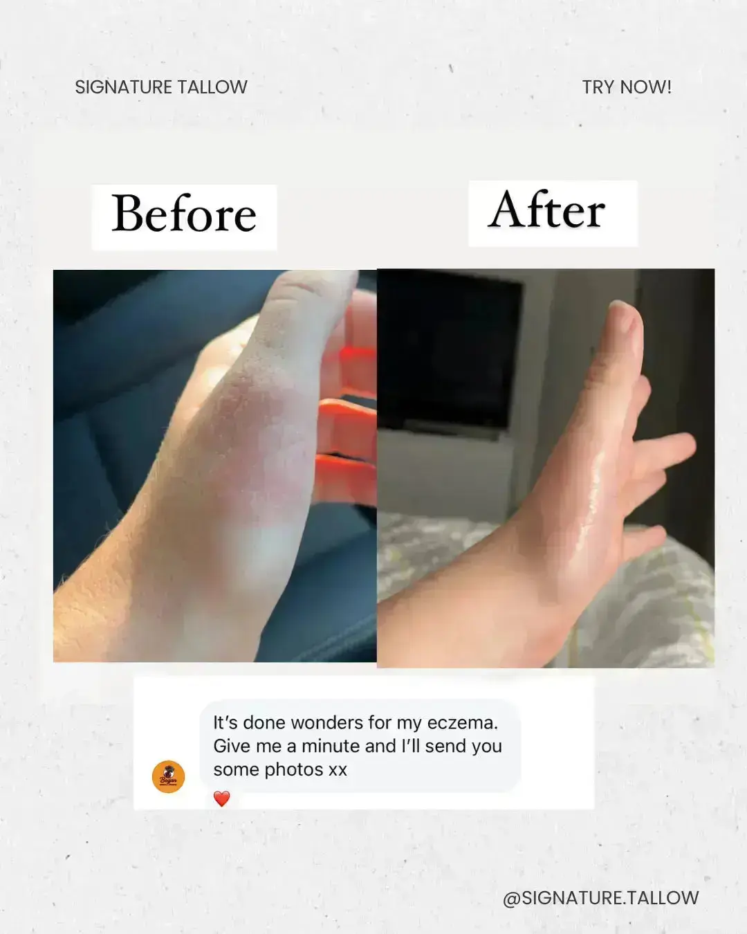 Unscented Moisturising Tallow Cream (Eczema & Psoriasis safe) Signature Tallow